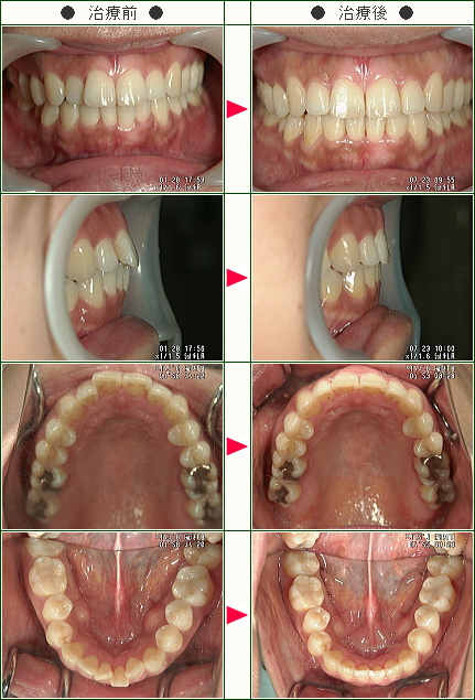 歯のデコボコ矯正症例(Ｍ様　３８歳　女性)