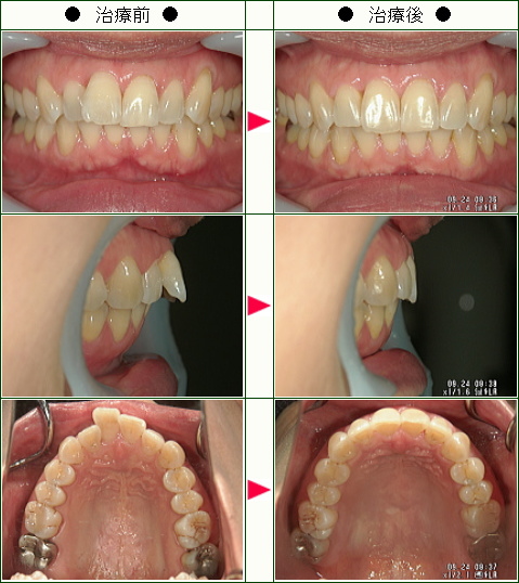 出っ歯矯正症例(Ｍ様　５２歳　女性)