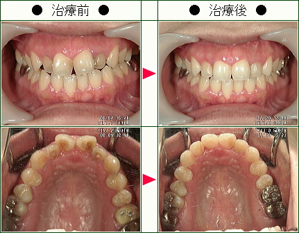 歯のデコボコ矯正症例(Ｍ・Ａ様　２９歳　女性)