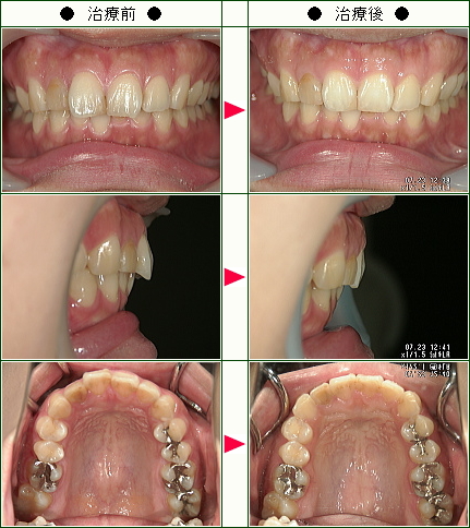 歯のデコボコ矯正症例(Ｍ.Ａ様　３０歳　女性)