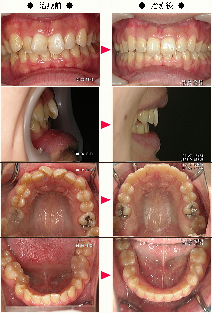 歯のデコボコ矯正症例［Ｍ・Ａ様　３０歳　女性］