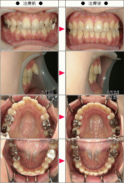 出っ歯矯正症例［Ｍ・Ａ様　３２歳　女性］