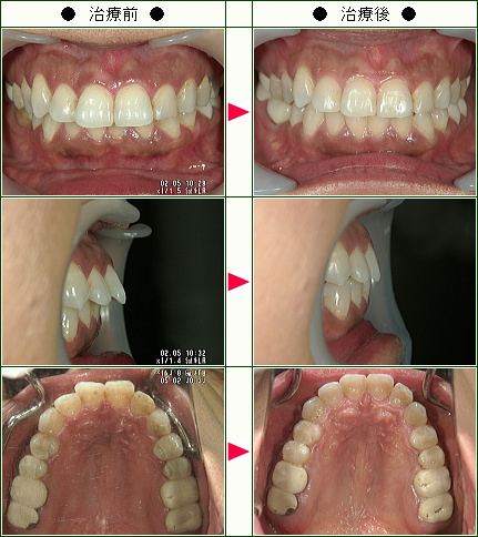 出っ歯矯正症例(Ｍ.Ａ様　４５歳　女性)