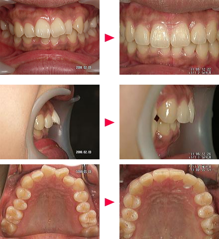 出っ歯症例の治療解説Ａ様