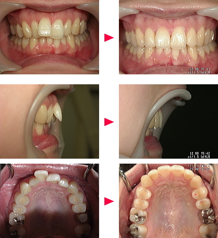 出っ歯症例の治療解説Ｂ様