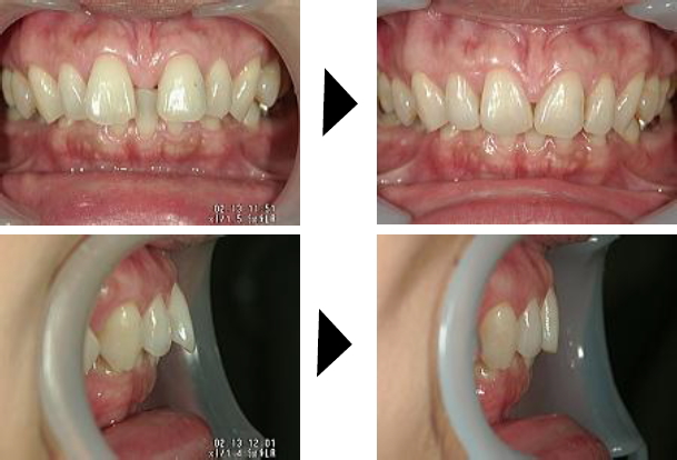 部分矯正ですきっ歯を治す 症例１