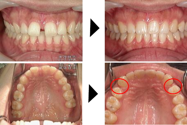 部分矯正ですきっ歯を治す 症例２
