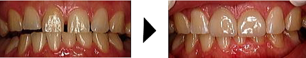 ラミネートベニアですきっ歯を治す