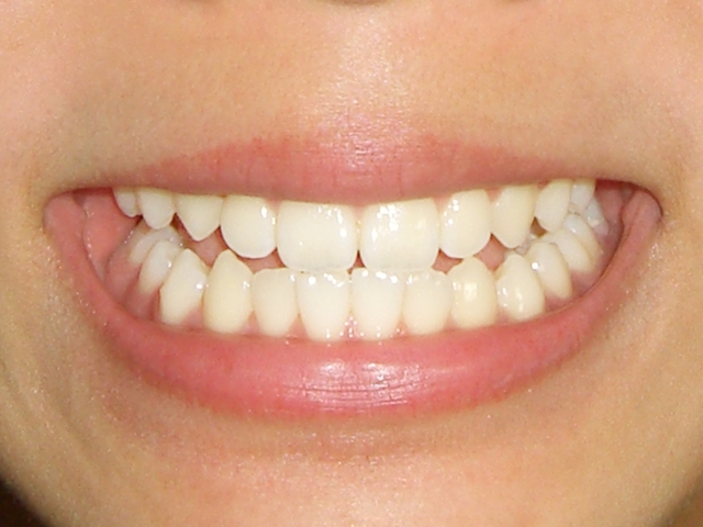 前歯の差し歯治療の特徴
