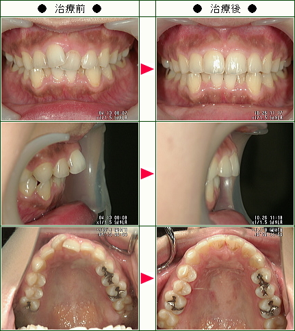 歯のデコボコ矯正症例(前田様　２７歳　女性)