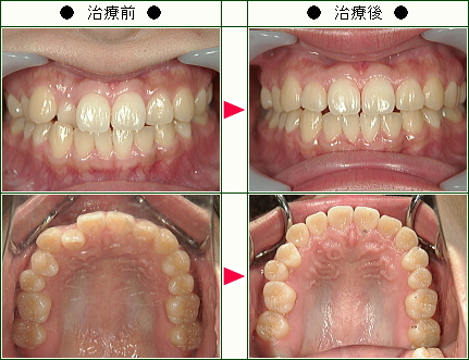 歯のデコボコ矯正症例(まほ様　２１歳　女性)