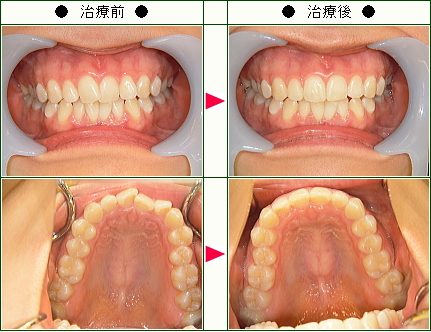 歯のデコボコ矯正症例(麻帆様　２２歳　女性)
