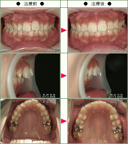 歯のデコボコ矯正症例(まい様　２４歳　女性)