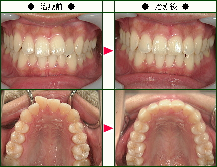 歯のデコボコ矯正症例(まいか様　２１歳　女性)