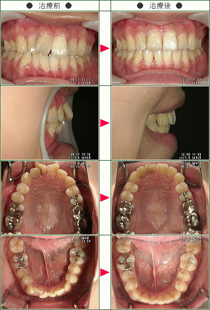 歯のデコボコ矯正症例(真希子様　２６歳　女性)