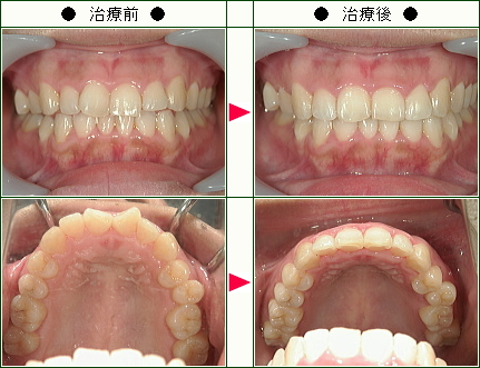 歯のデコボコ矯正症例(ＭＡＭＩ様　２８歳　女性)