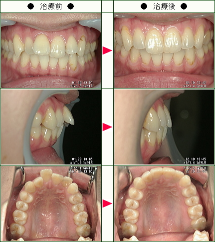 歯のデコボコ矯正症例(Ｍａｎａ様　３２歳　女性)