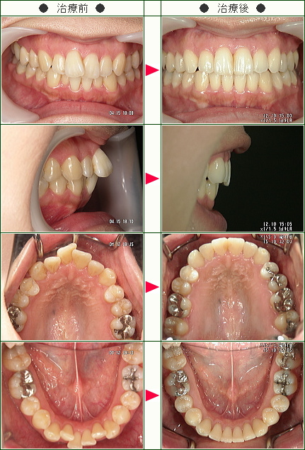 歯のデコボコ矯正症例(Manzana様　３１歳　女性)
