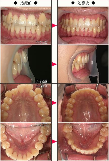 歯のデコボコ矯正症例［Maple様　３３歳　女性］