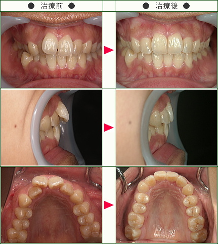歯のデコボコ矯正症例(増田様　２６歳　女性)