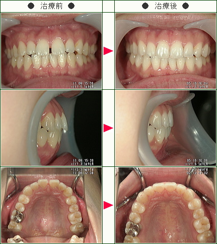 前歯のすきっ歯矯正症例(マスダ様　２６歳　女性)