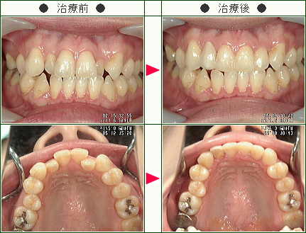 歯のデコボコ矯正症例(松井様　３５歳　女性)