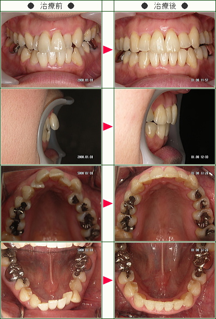 出っ歯矯正症例(松井様　４０歳　女性)