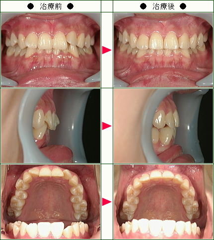 歯のデコボコ矯正症例(マツオ様　２０歳　女性)