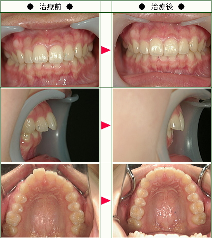 出っ歯矯正症例(松岡様　２０歳　女性)