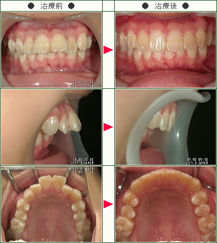 出っ歯矯正症例(Ｍａｙ様　１３歳　女性)