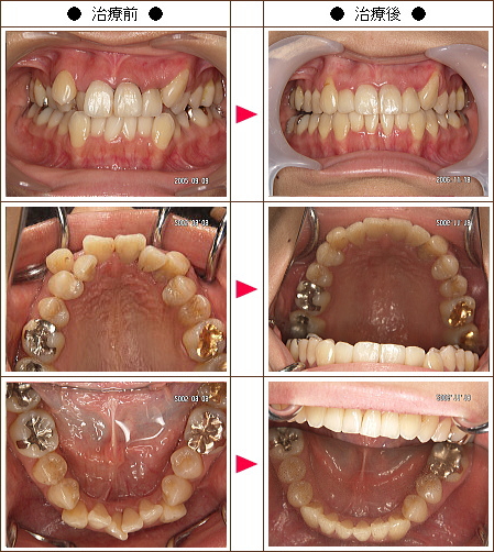 歯のデコボコ矯正症例［Ｍ.Ｂ.様　３４歳　女性］