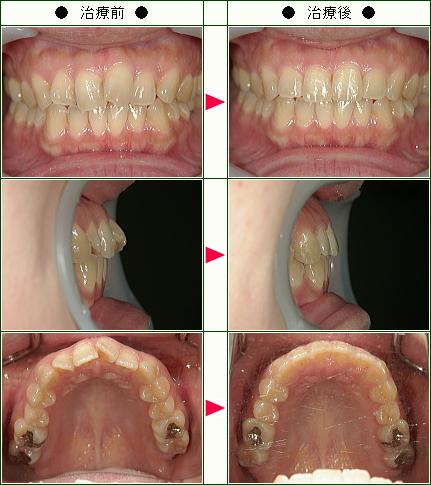 歯のデコボコ矯正症例(めぐみ様　３５歳　女性)