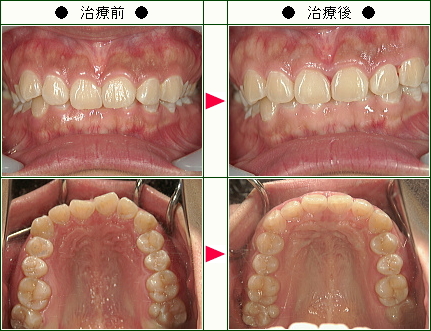 歯のデコボコ矯正症例(メイ様　２９歳　女性)