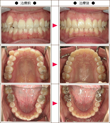 歯のデコボコ矯正症例［メロン様　２８歳　女性］