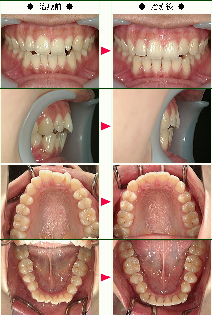 歯のデコボコ矯正症例(Merci0607様　２８歳　女性)
