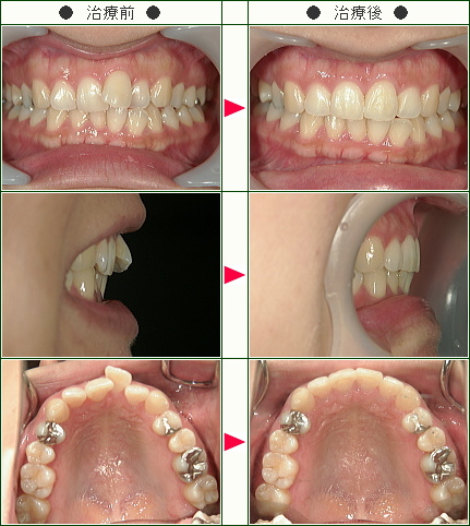 歯のデコボコ矯正症例(Ｍ.Ｆ様　２７歳　女性)