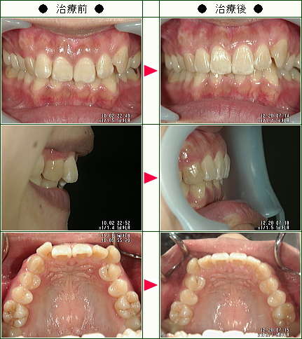 歯のデコボコ矯正症例(Ｍ.Ｇ様　３２歳　女性)