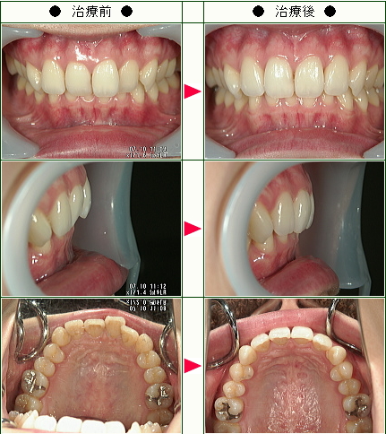 歯のデコボコ矯正症例(Ｍ．Ｇ様　３２歳　女性)
