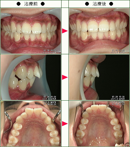 出っ歯矯正症例(Ｍ.Ｈ様　１９歳　女性)