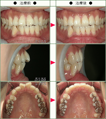 歯のデコボコ矯正症例(Ｍ．Ｈ様　２８歳　女性)