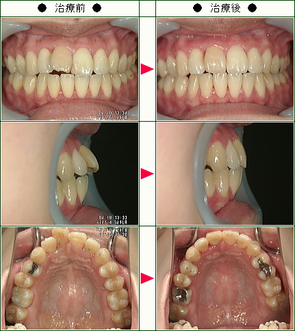 歯のデコボコ矯正症例(Ｍ・Ｈ様　２９歳　女性)