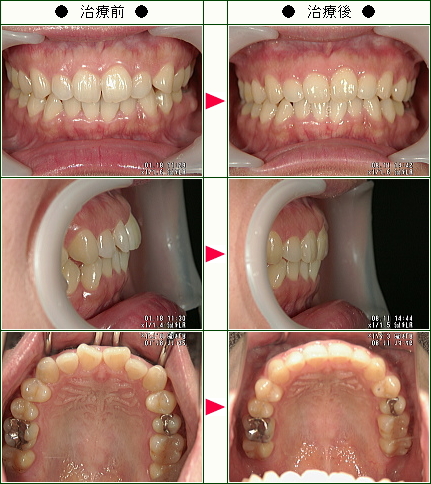 歯のデコボコ矯正症例(Ｍ．Ｈ．様　３８歳　女性)