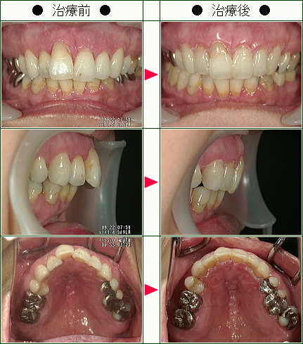 歯のデコボコ矯正症例(Ｍ．Ｈ様　４２歳　女性)