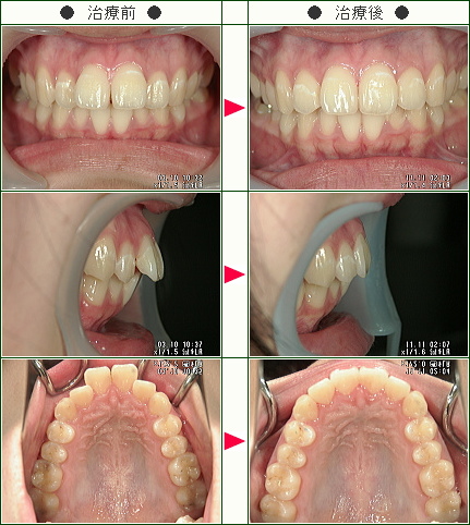 出っ歯矯正症例(Ｍ.Ｉ様　１６歳　女性)