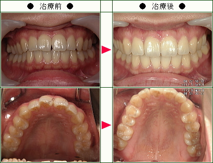 前歯のすきっ歯矯正症例(Ｍ．Ｉ．様　２６歳　女性)