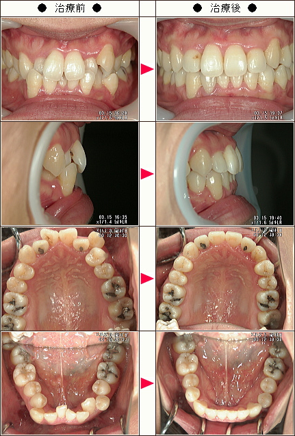 歯のデコボコ矯正症例［Ｍ．Ｉ様　３１歳　女性］