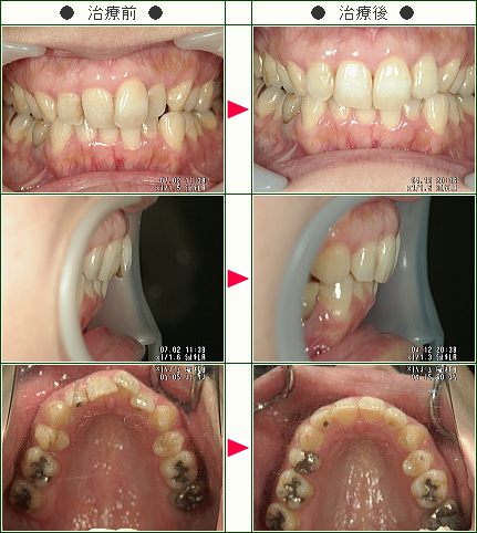 歯のデコボコ矯正症例(Ｍ・Ｉ様　３８歳　女性)