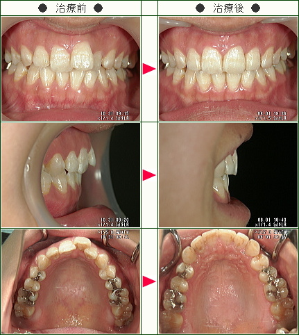 歯のデコボコ矯正症例(道家様　２６歳　女性)