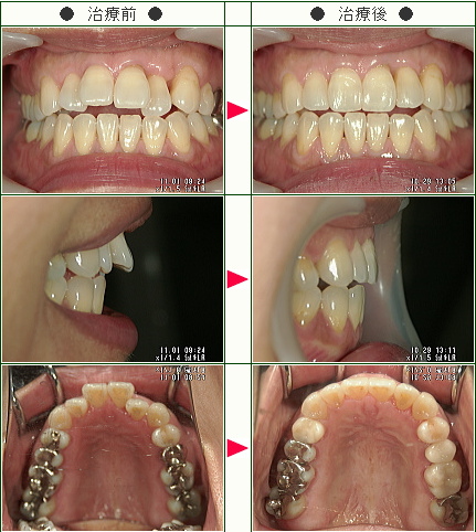 出っ歯矯正症例(みちにゃん様　５３歳　女性)