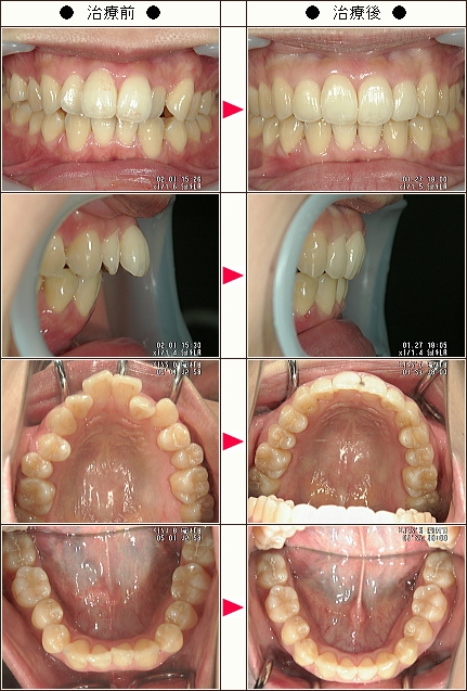 出っ歯矯正症例［ミー様　２９歳　女性］
